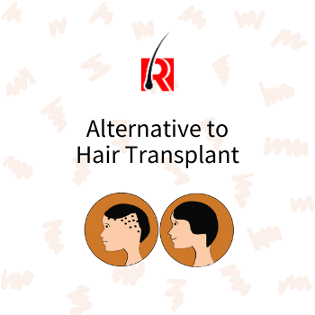 Alternative of Hair Transplant