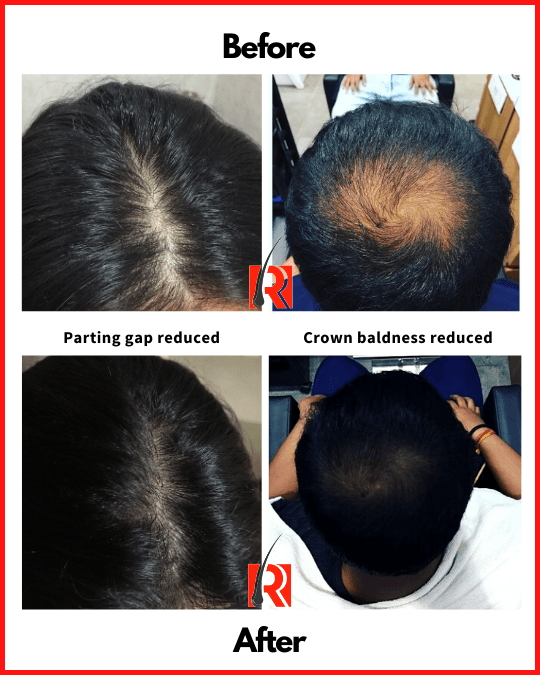 Natural Alopecia Cure | Regena Roots®