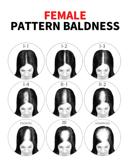 Female Pattern Baldness Solution
