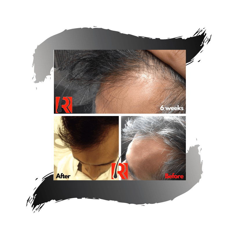 Premature Grey Hair Treatment | Regena Roots® | White Hair