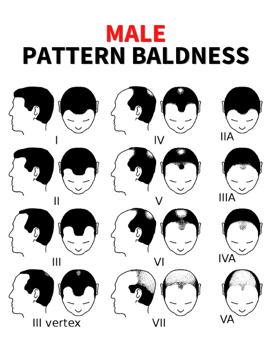 Guaranteed baldness solution